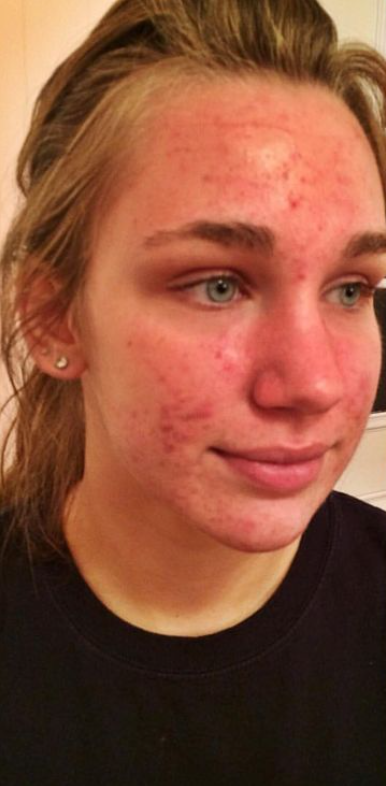 Woman with dull, dry skin before using the skincare set