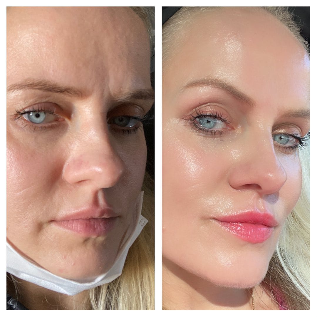 Glowvu 2-Step Lip Sculpt Ritual kit with serum and roller