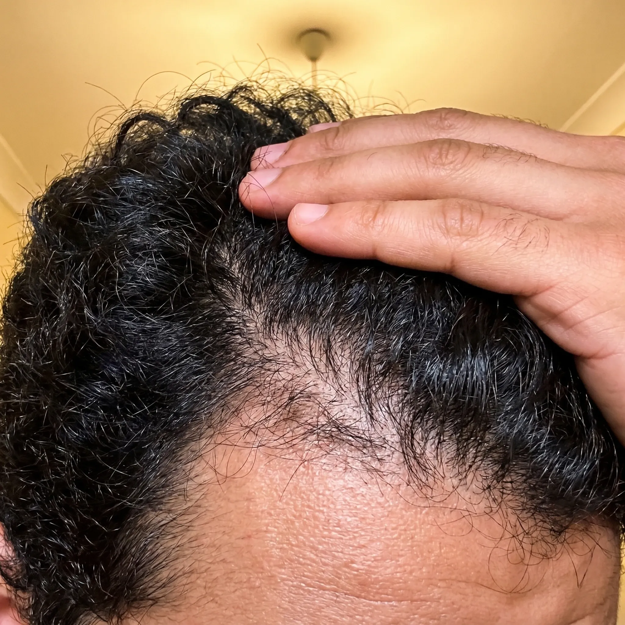 Homme avec une chevelure visiblement plus dense, regard confiant.