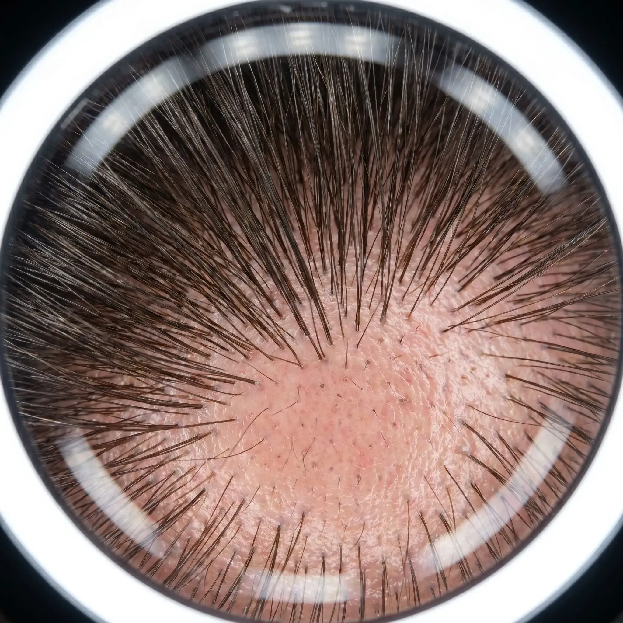 Vidéo montrant l'application de DENSIRA et les résultats