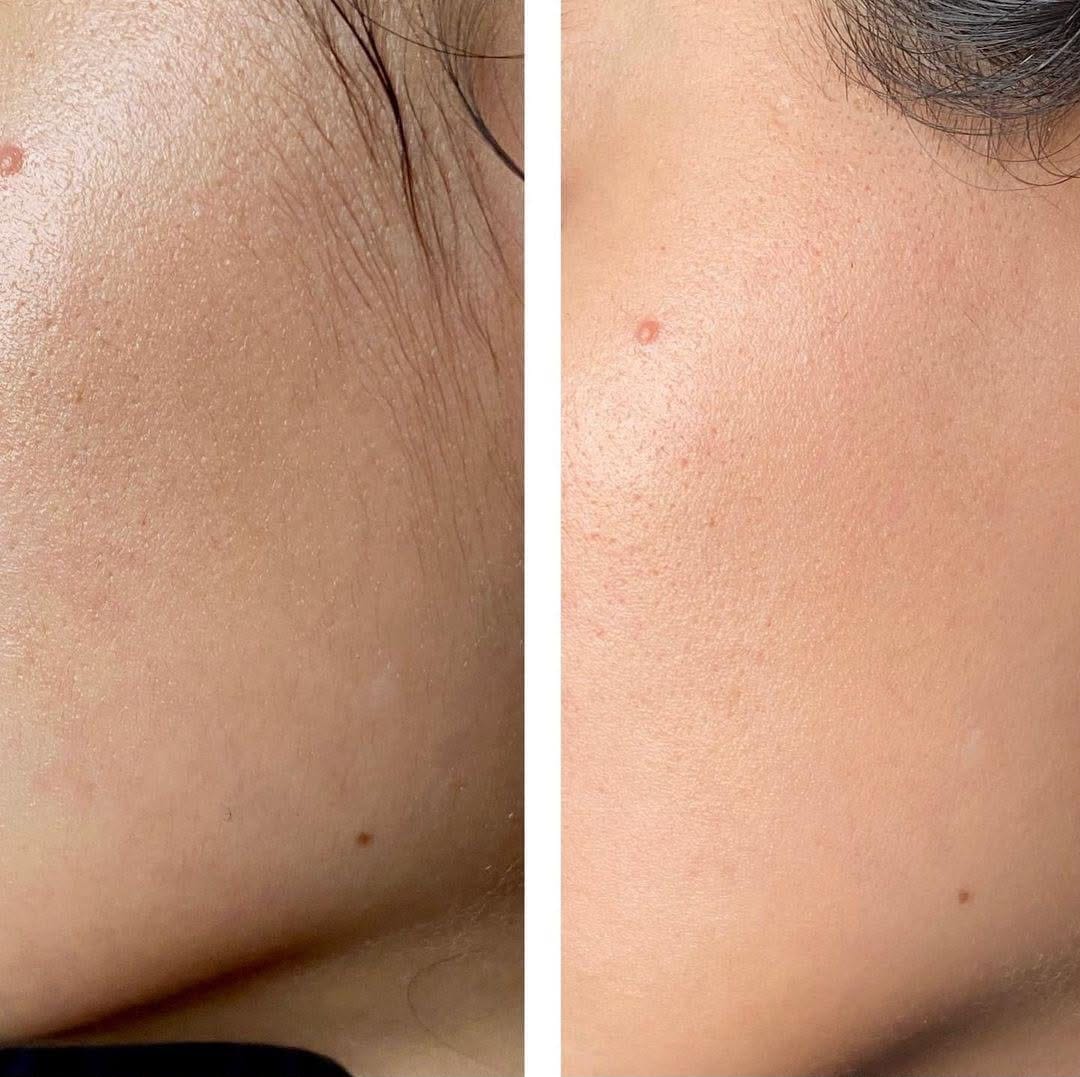صورة قبل استخدام المنتج لإزالة الشعر