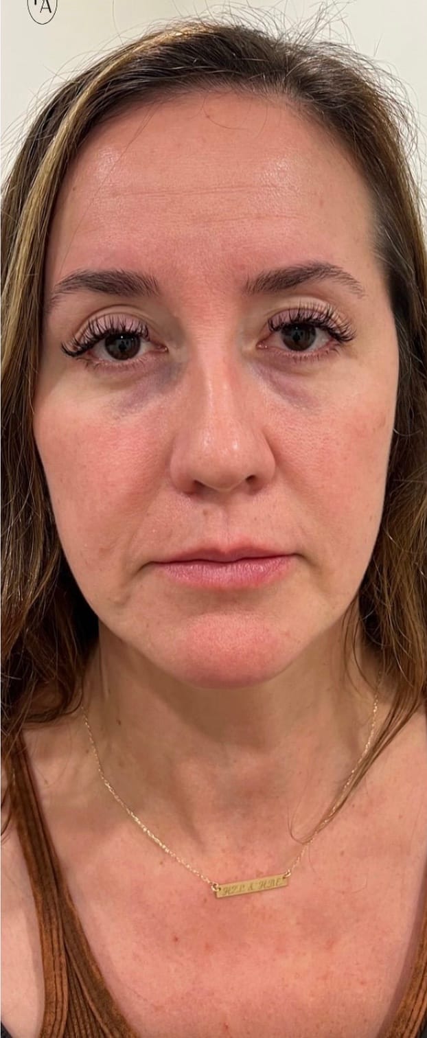 User's skin before applying the sleeping mask