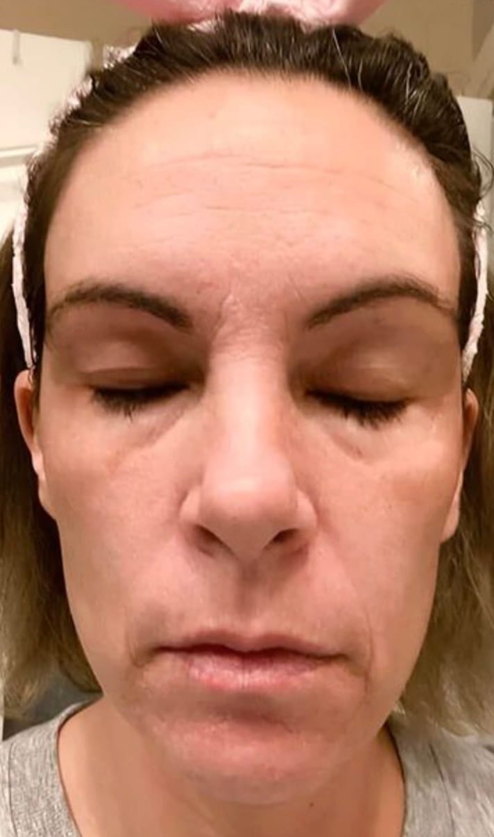 Rough texture of skin before mask