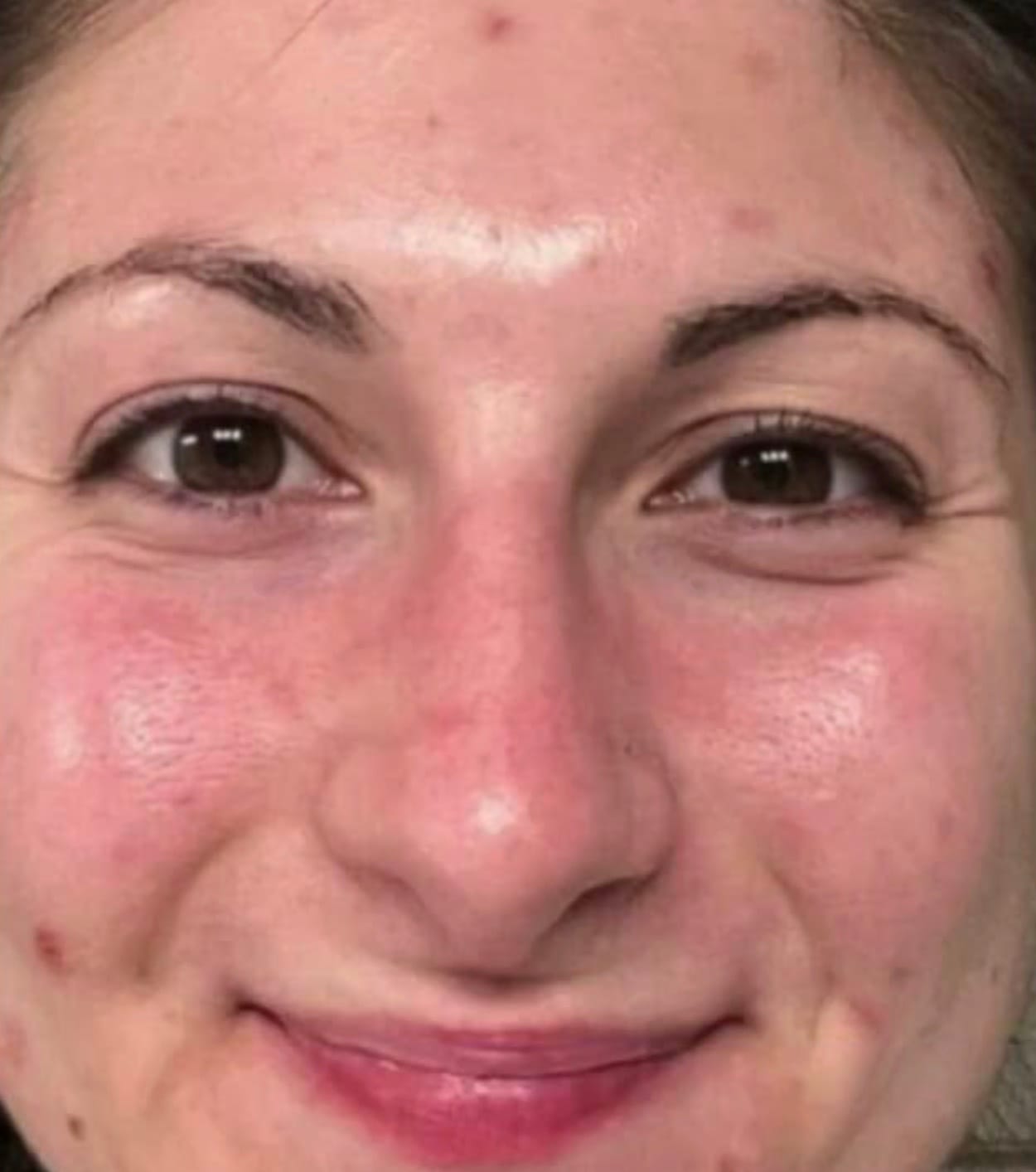 Dull complexion prior to mask use