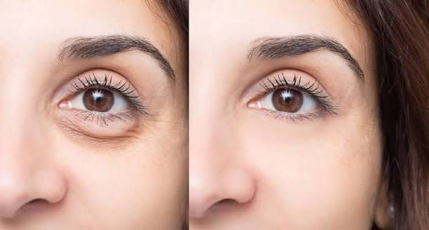 Cooling eye puffiness reduction
