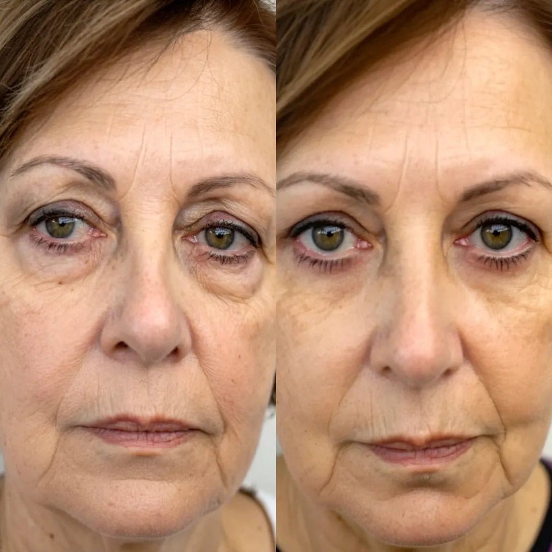 Non-invasive fat pad reduction technology