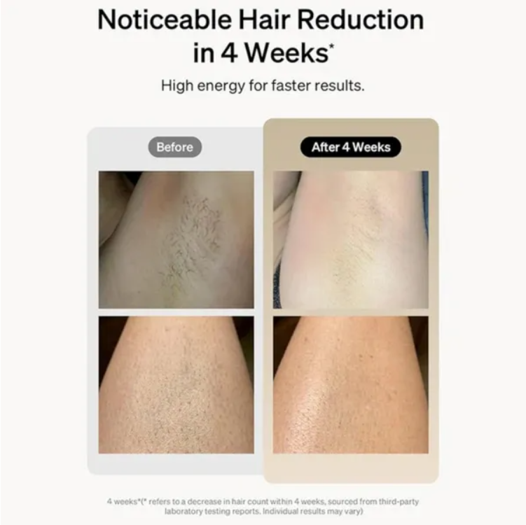 IPL hair removal device showing sleek design