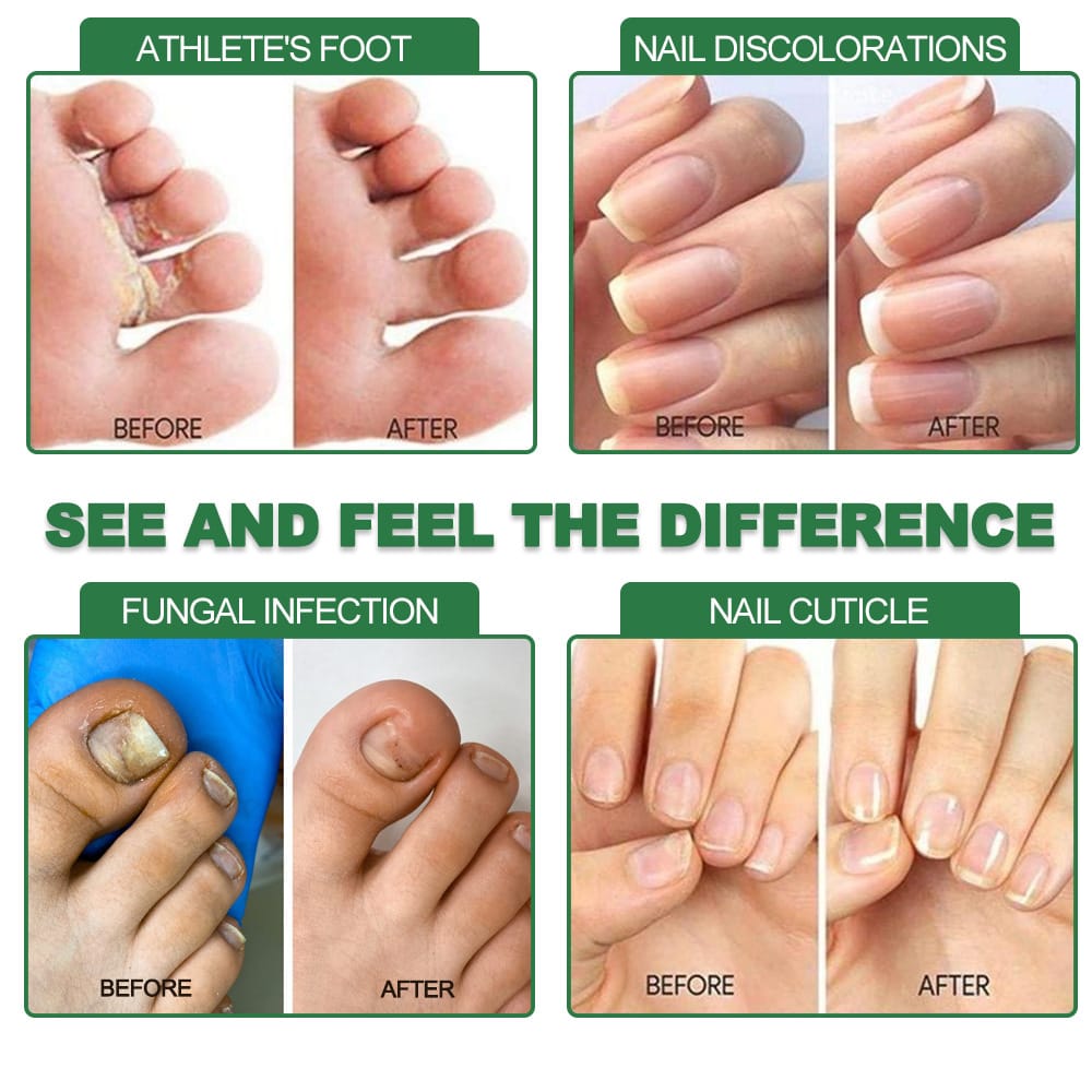 Application of nail serum to strengthen brittle and thin damaged fingernails
