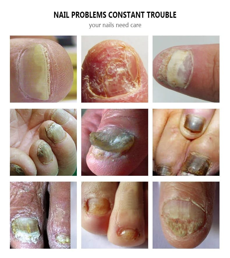 Person applying the restorative nail serum to a toe for treatment
