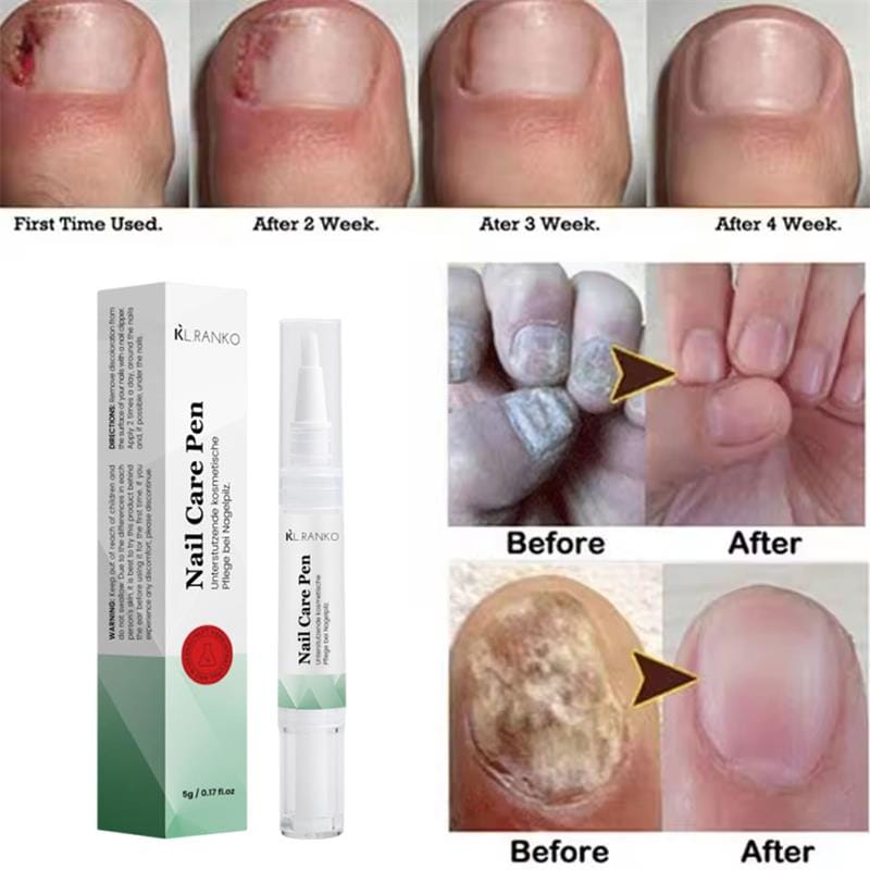 Nail Fungal Treatment Serum Foot Toe Nail Fungus Removal Essential Oil Anti Infection Onychomycosis Paronychia Repairing Care