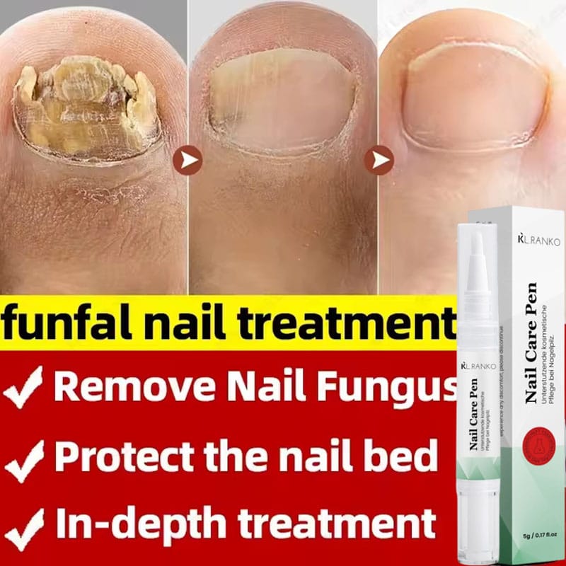 Nail Fungal Treatment Serum Foot Toe Nail Fungus Removal Essential Oil Anti Infection Onychomycosis Paronychia Repairing Care